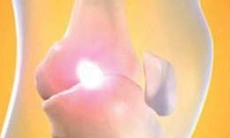 Phương pháp phẫu thuật khớp gối ít xâm lấn